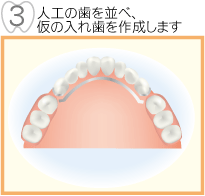 3人工歯を並べ、仮の入れ歯を作製